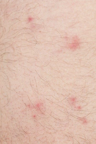 What Does a Flea Bite Look Like?